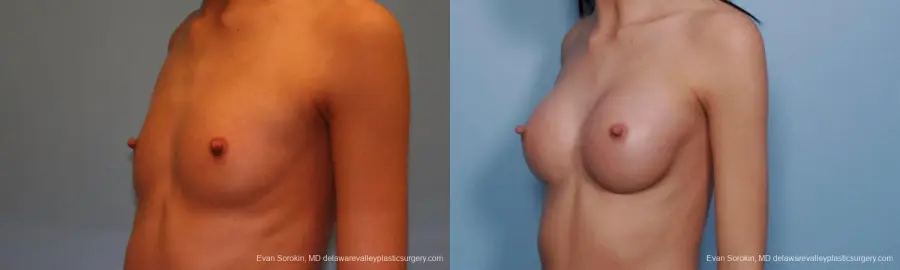 Philadelphia Breast Augmentation 9377 - Before and After 4