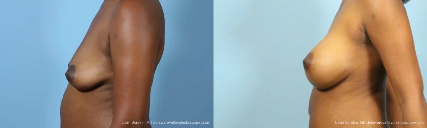 Philadelphia Breast Augmentation 9173 - Before and After 5