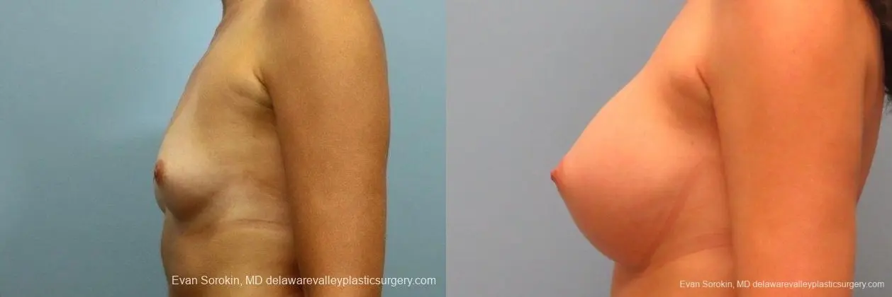 Philadelphia Breast Augmentation 8764 - Before and After 5