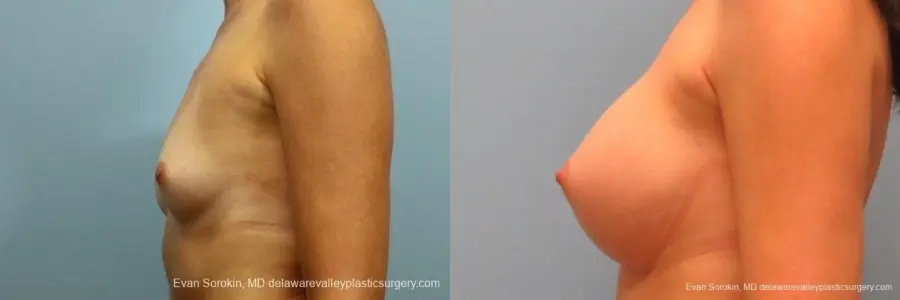 Philadelphia Breast Augmentation 8764 - Before and After 5