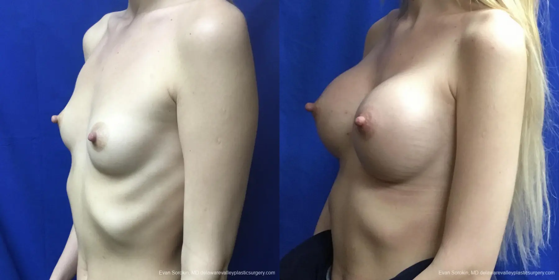 Breast Augmentation: Patient 167 - Before and After 4