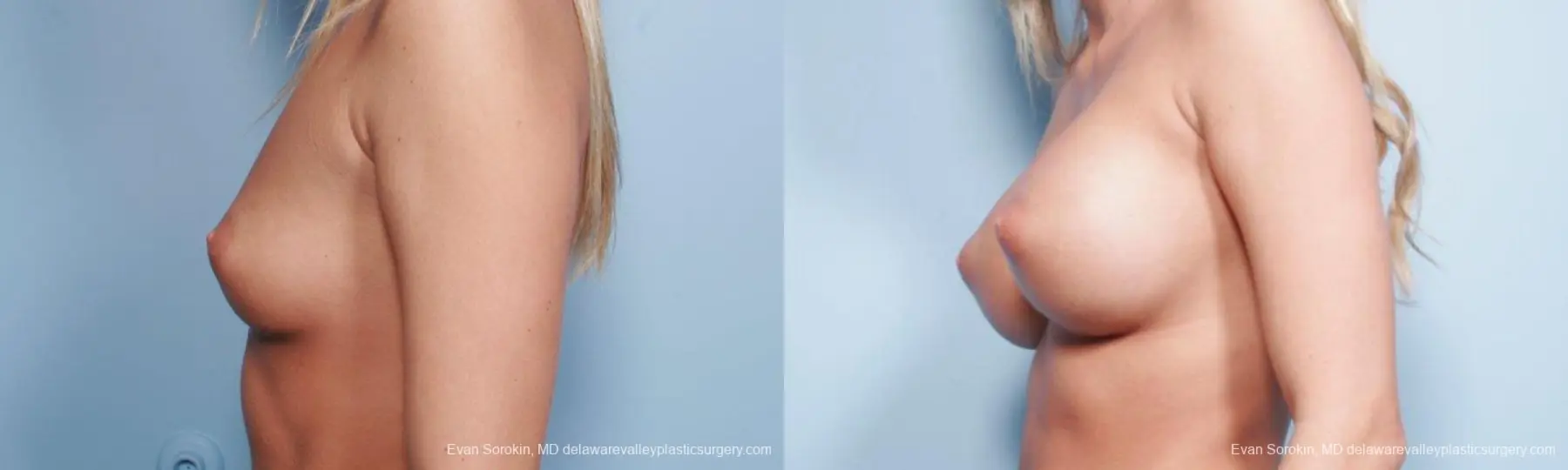 Philadelphia Breast Augmentation 9177 - Before and After 3