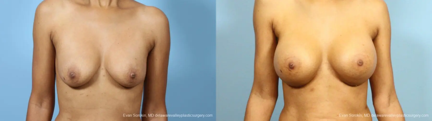 Philadelphia Breast Augmentation 9288 - Before and After 1