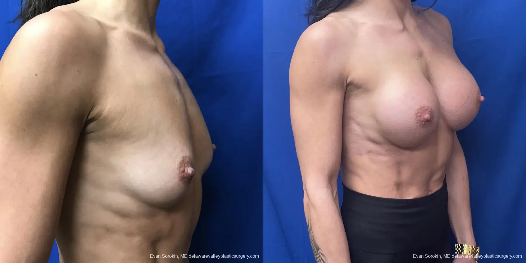 Breast Augmentation: Patient 218 - Before and After 2