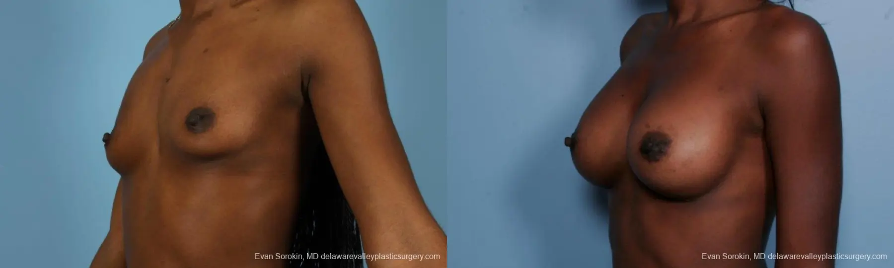 Philadelphia Breast Augmentation 8655 - Before and After 4