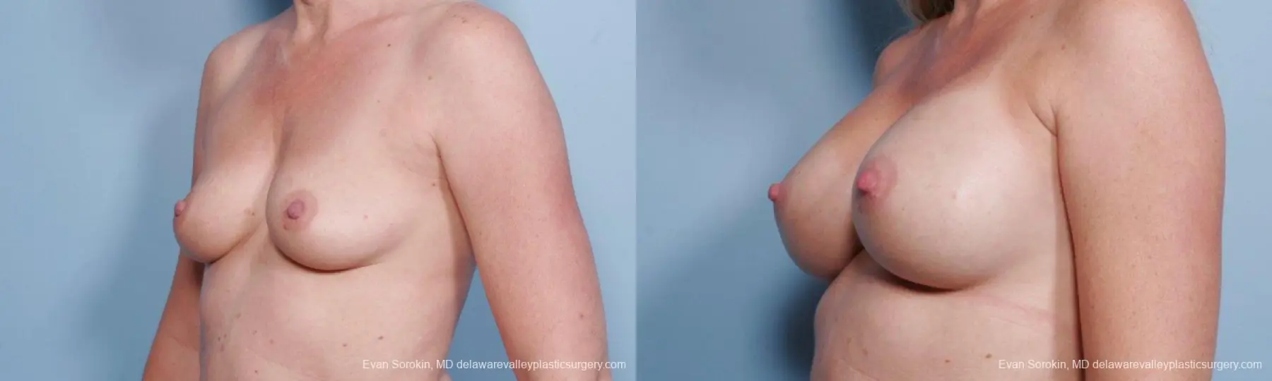 Philadelphia Breast Augmentation 9178 - Before and After 4