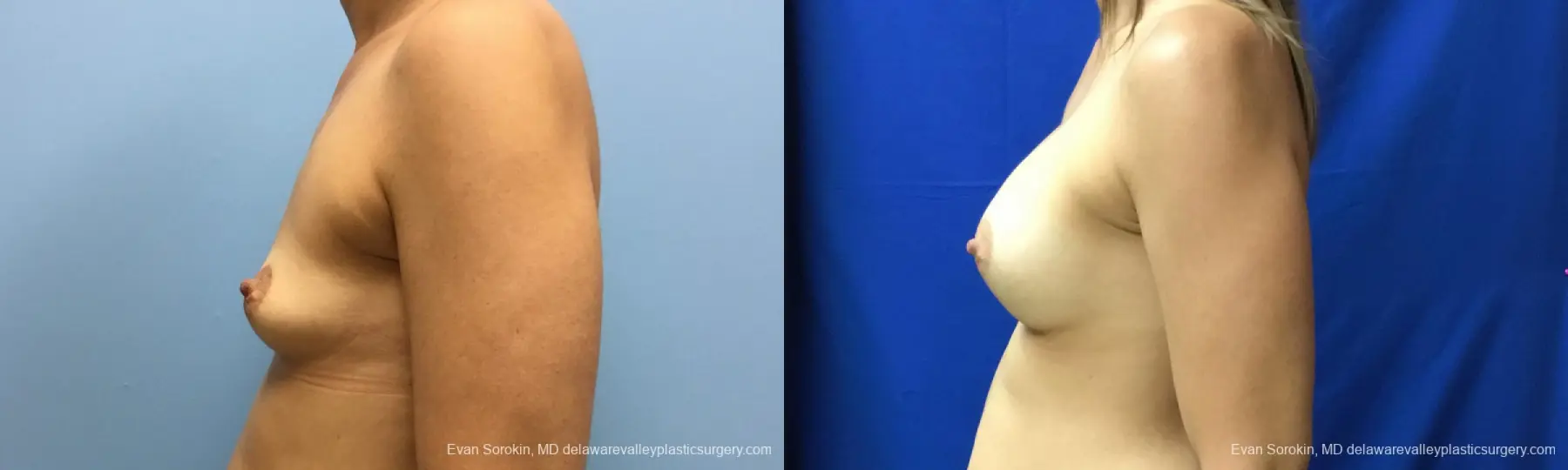 Philadelphia Breast Augmentation 12519 - Before and After 5