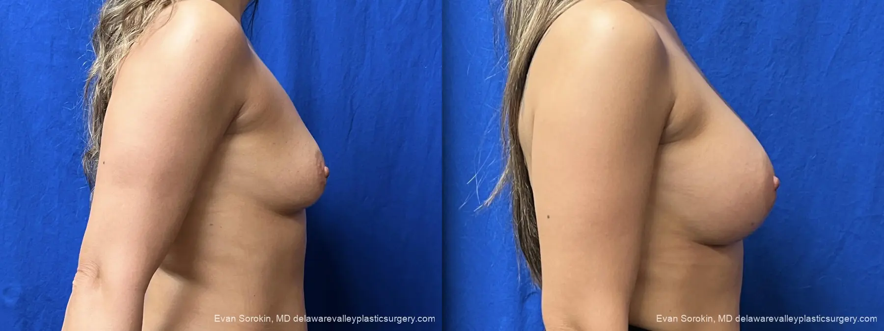 Breast Augmentation: Patient 329 - Before and After 3