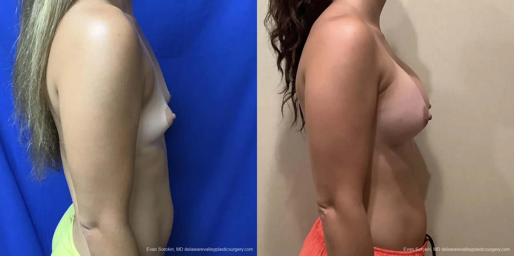 Breast Augmentation: Patient 214 - Before and After 3