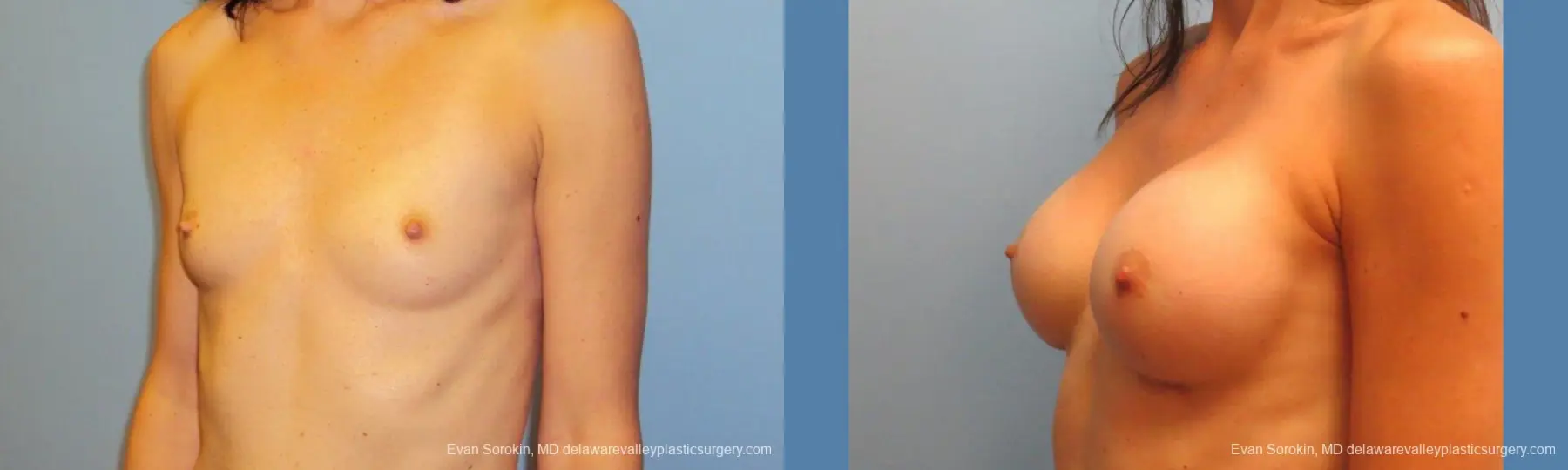 Philadelphia Breast Augmentation 9417 - Before and After 4