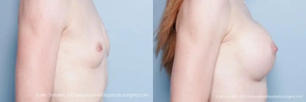 Philadelphia Breast Augmentation 9169 - Before and After 3