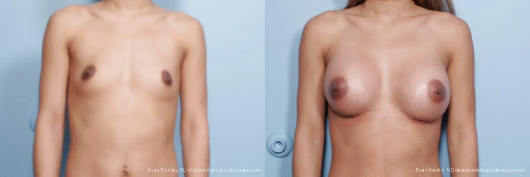 Philadelphia Breast Augmentation 9106 - Before and After 1
