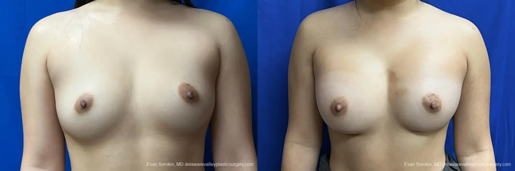 Breast Augmentation: Patient 244 - Before and After 1