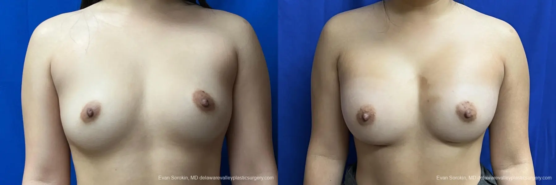 Breast Augmentation: Patient 212 - Before and After 1