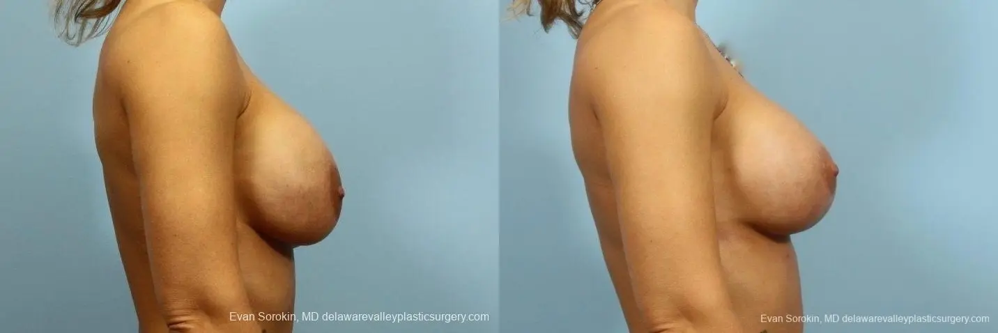 Philadelphia Breast Augmentation 8709 - Before and After 4