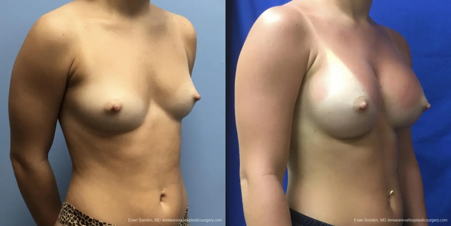 Breast Augmentation: Patient 191 - Before and After 2