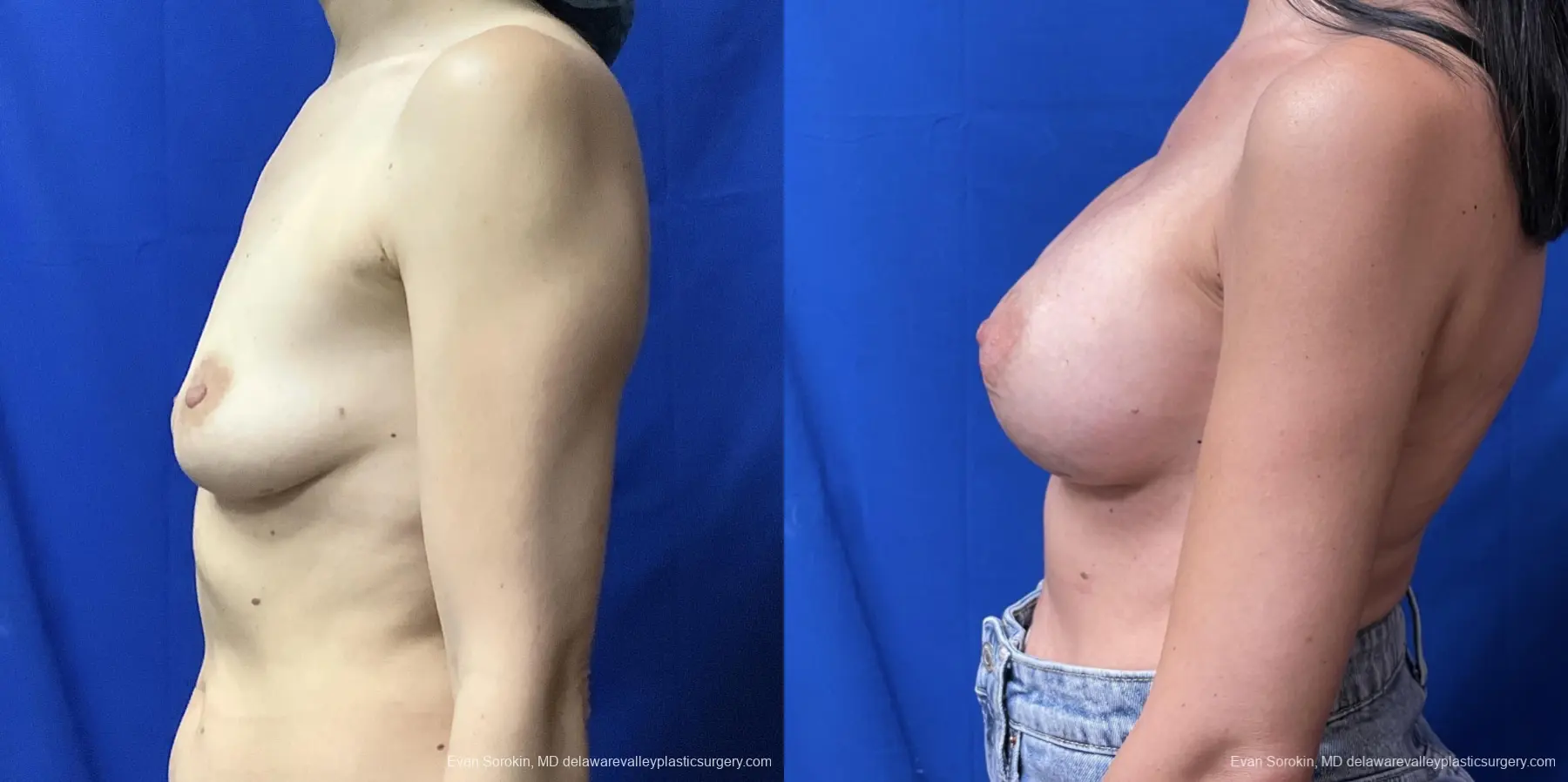 Breast Augmentation: Patient 173 - Before and After 5