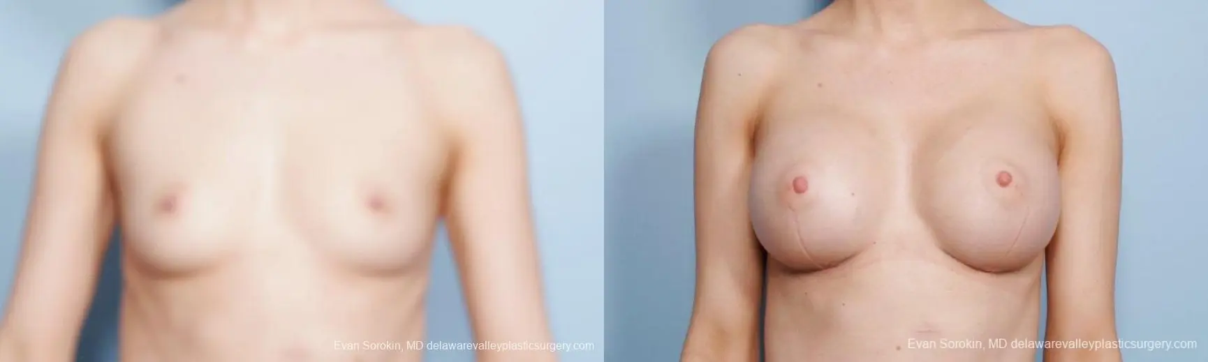 Philadelphia Breast Augmentation 8663 - Before and After 1