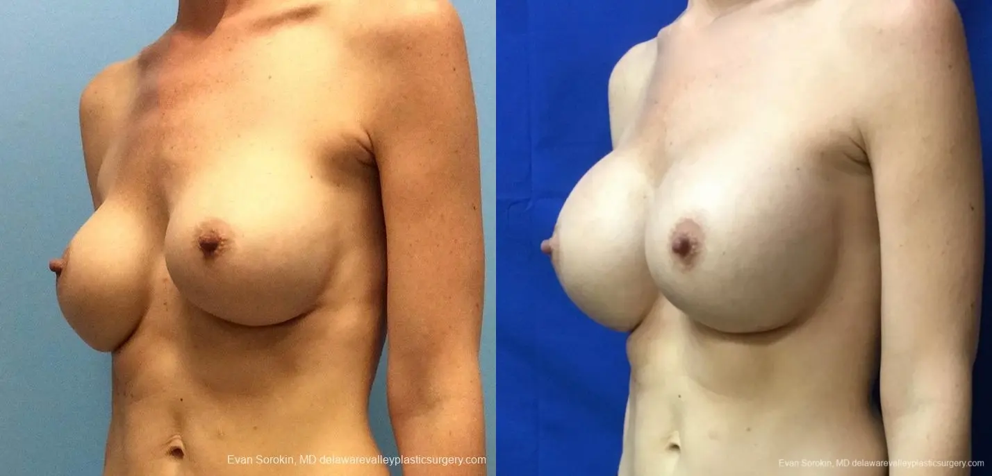 Philadelphia Breast Augmentation 13069 - Before and After 4