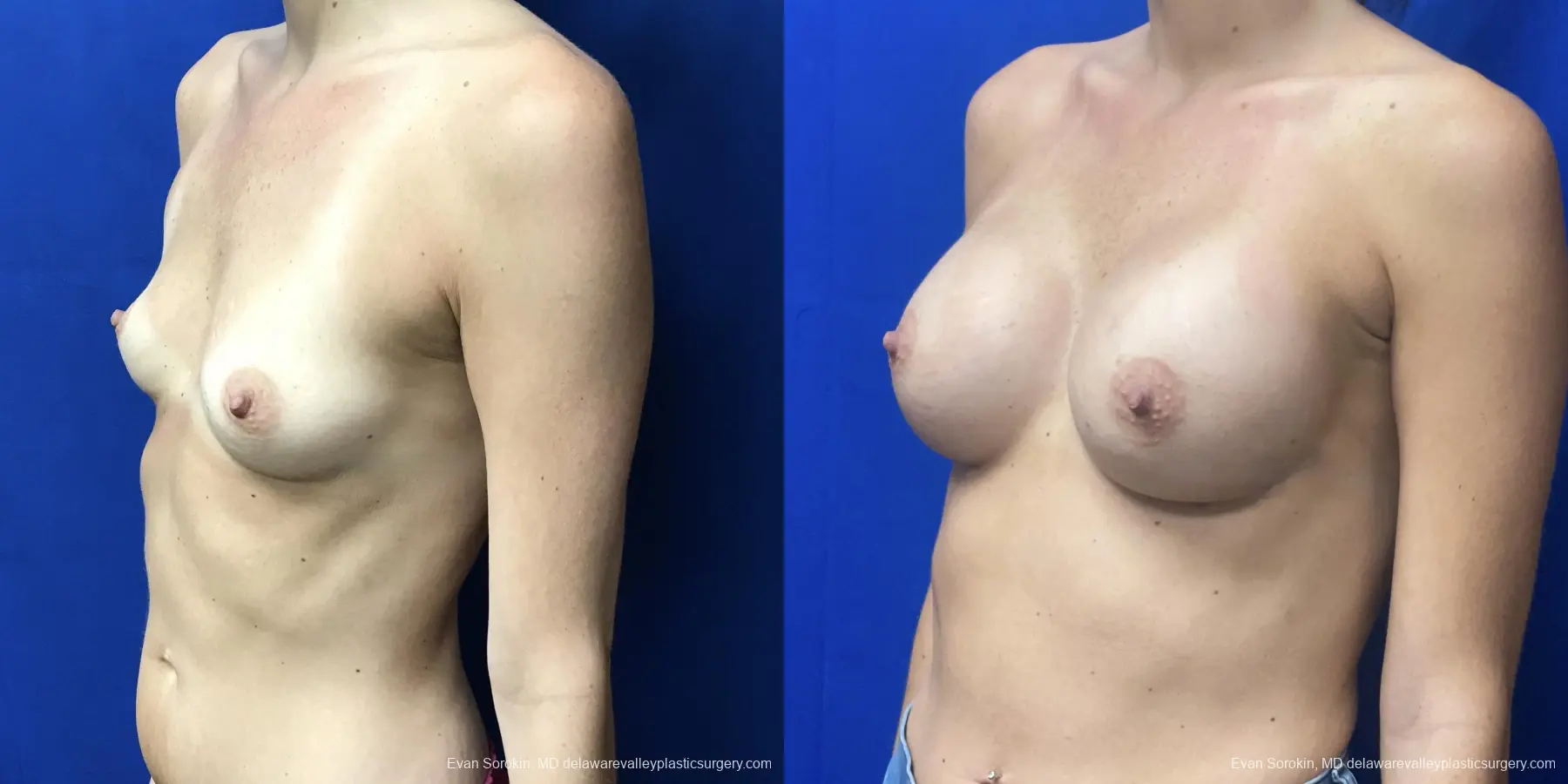 Breast Augmentation: Patient 184 - Before and After 4