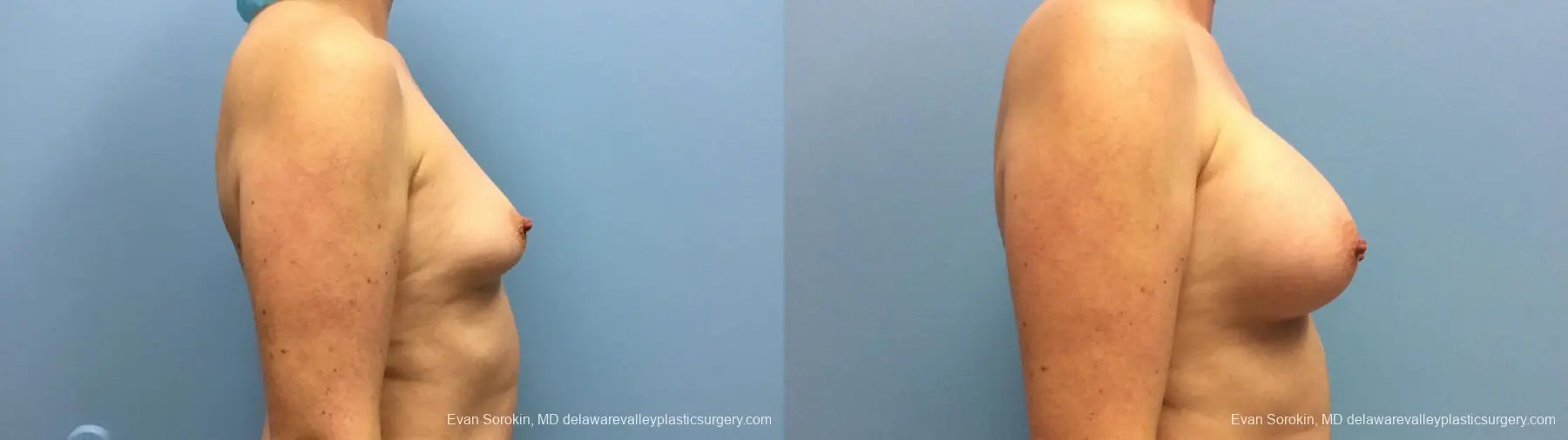 Philadelphia Breast Augmentation 13181 - Before and After 3