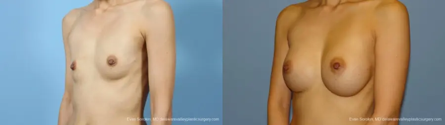Philadelphia Breast Augmentation 9291 - Before and After 4