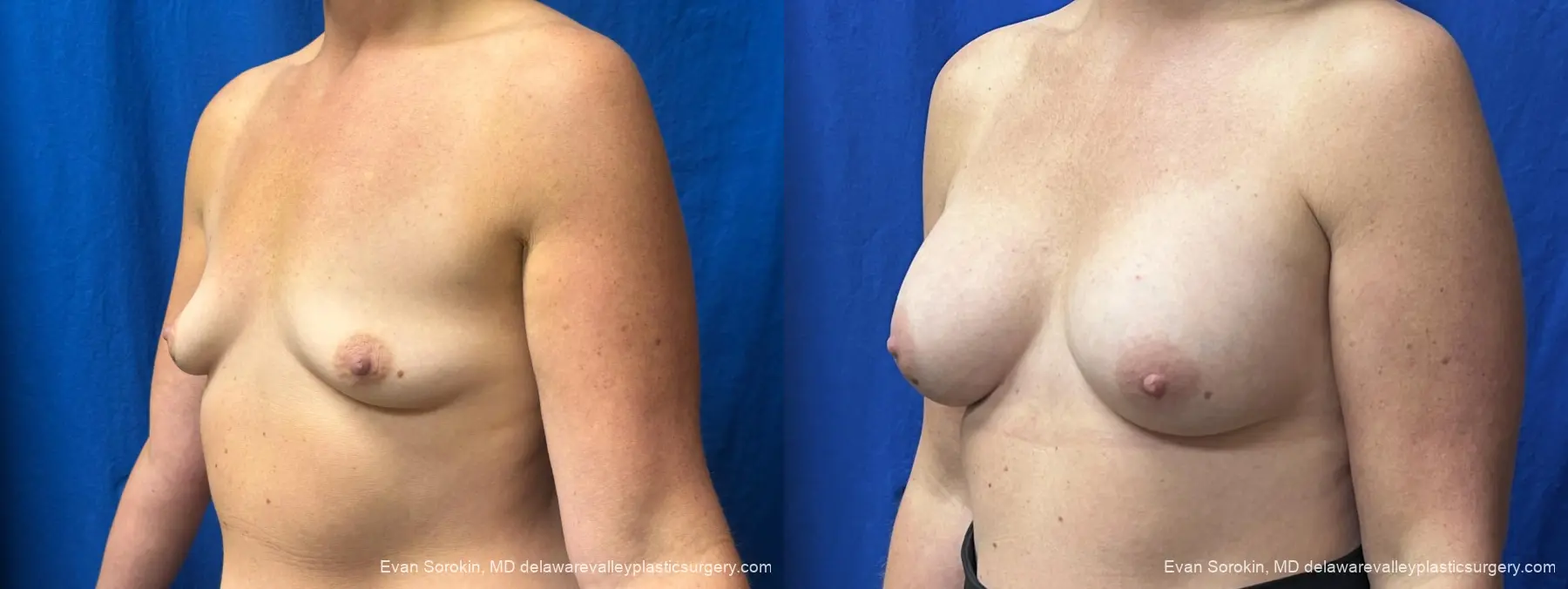 Breast Augmentation: Patient 337 - Before and After 4