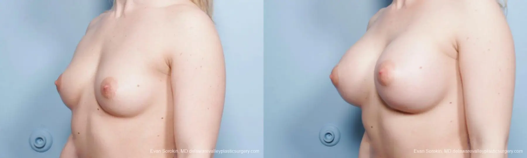 Breast Augmentation: Patient 130 - Before and After 4