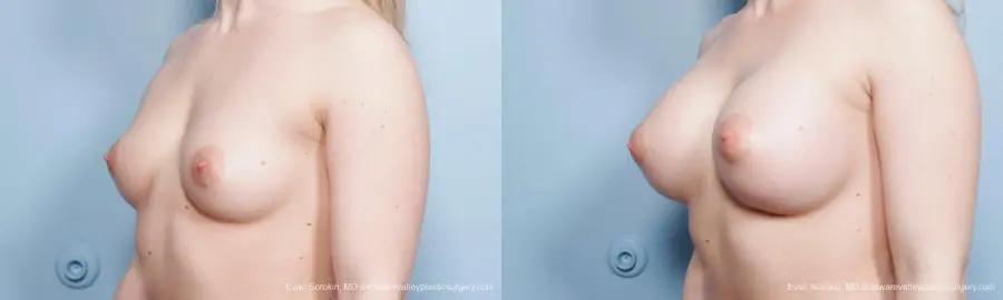 Breast Augmentation: Patient 129 - Before and After 4