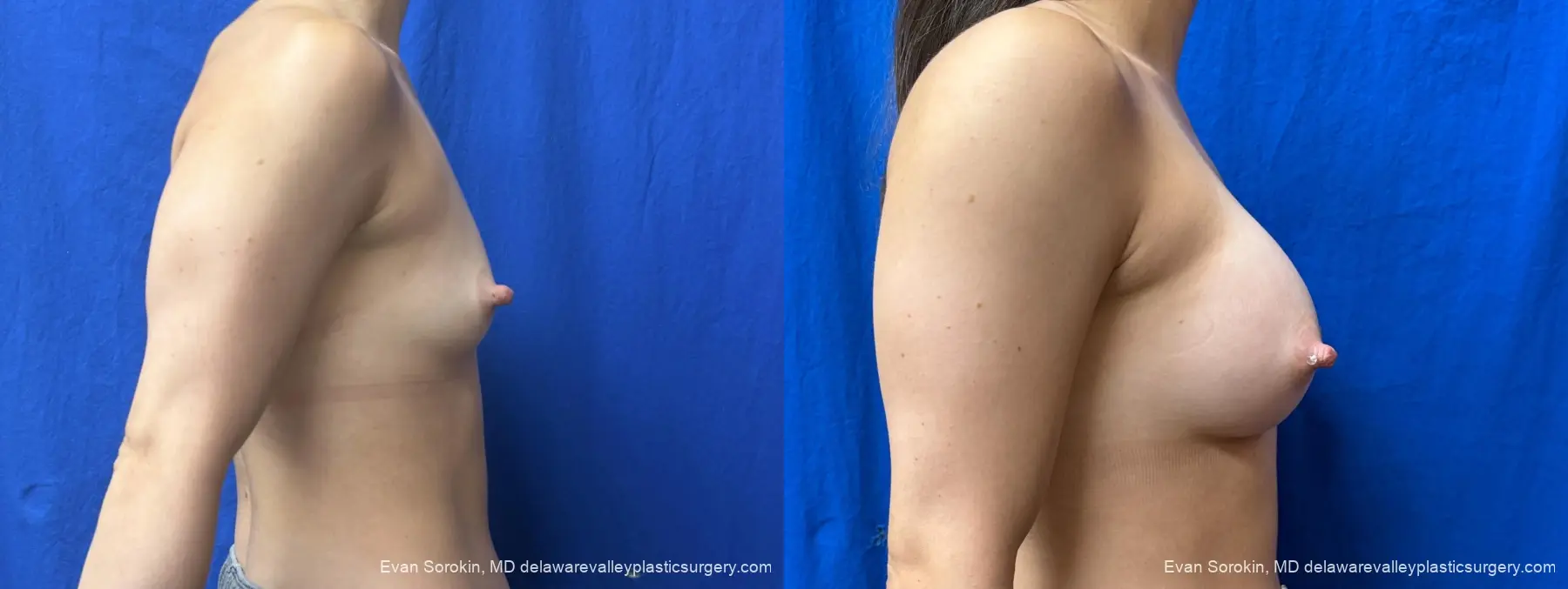 Breast Augmentation: Patient 278 - Before and After 3