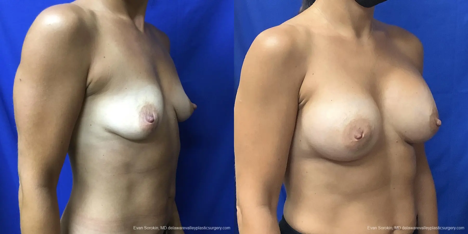 Breast Augmentation: Patient 187 - Before and After 2