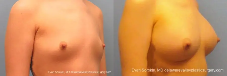 Philadelphia Breast Augmentation 10113 - Before and After 2