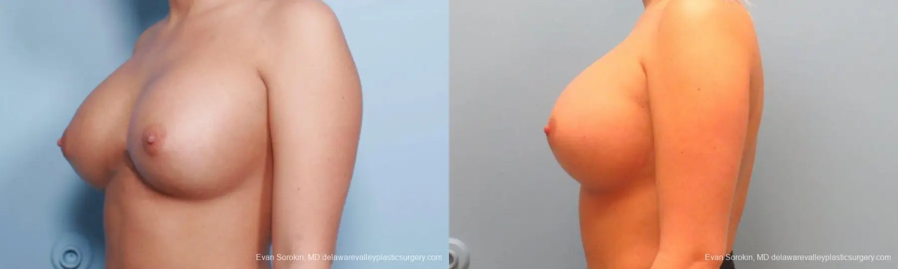 Philadelphia Breast Augmentation 9394 - Before and After 5
