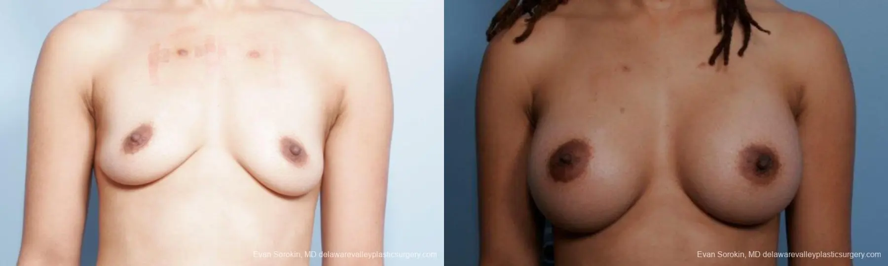 Philadelphia Breast Augmentation 9305 - Before and After