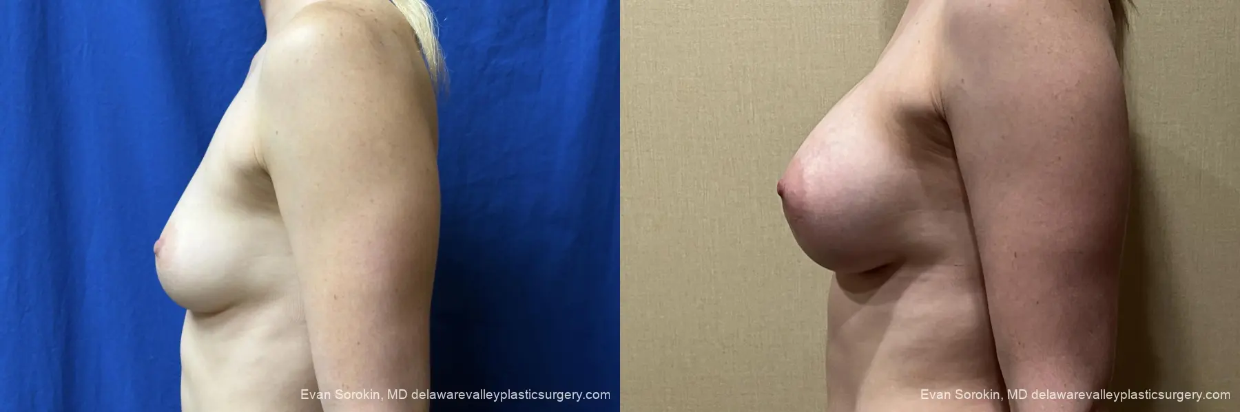 Breast Augmentation: Patient 338 - Before and After 5