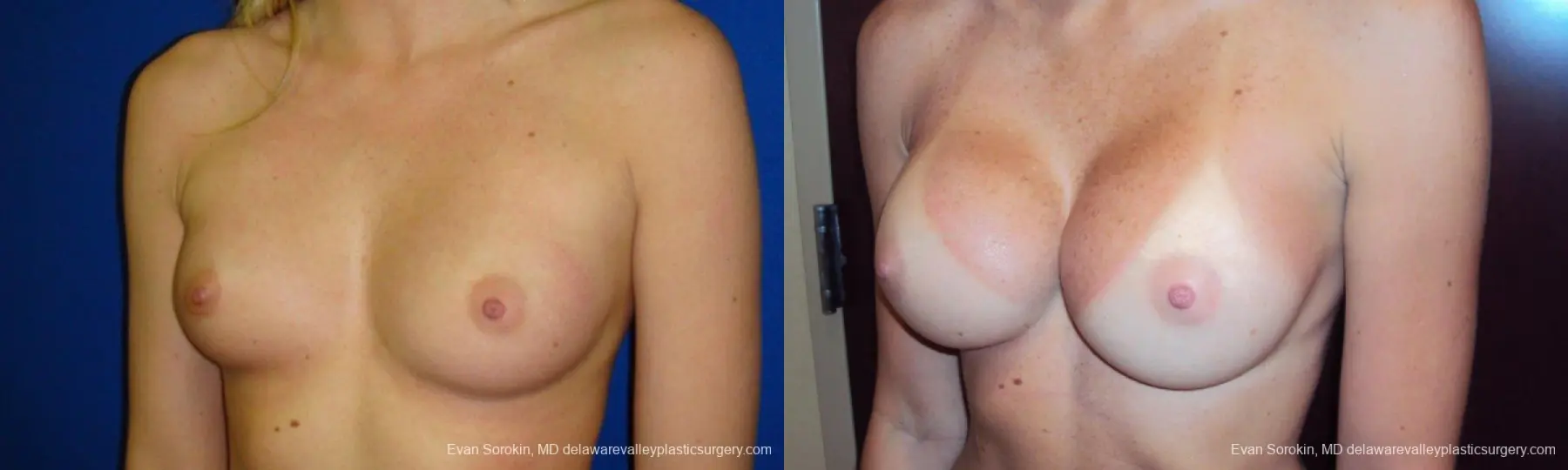 Philadelphia Breast Augmentation 9293 - Before and After 4