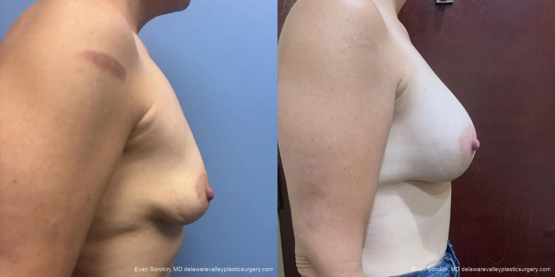 Breast Augmentation: Patient 301 - Before and After 3