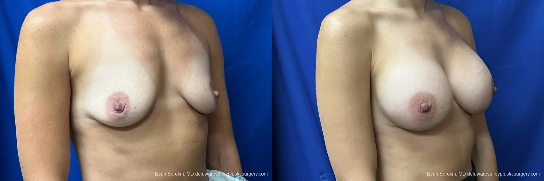 Breast Augmentation: Patient 203 - Before and After 2