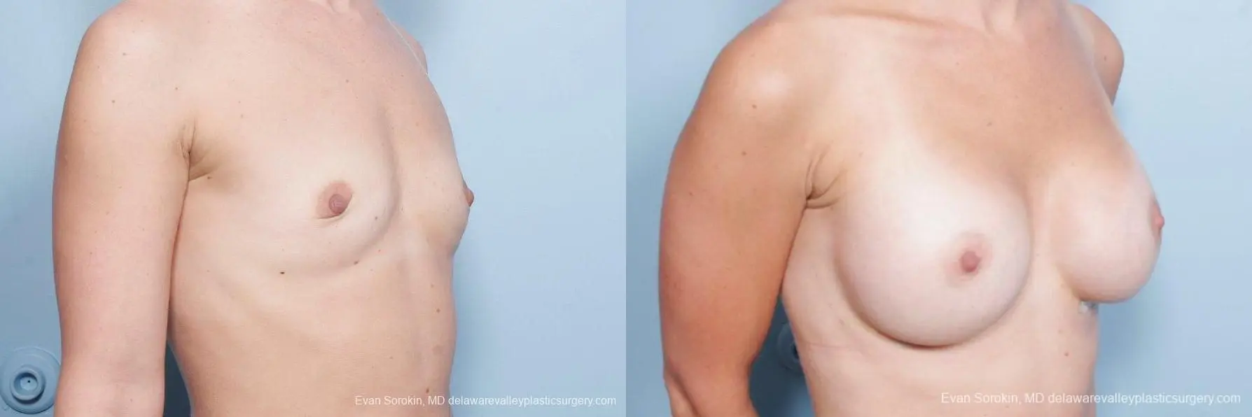 Philadelphia Breast Augmentation 8651 - Before and After 2