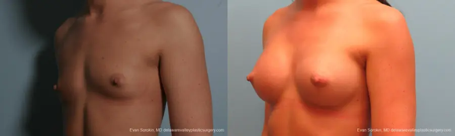 Philadelphia Breast Augmentation 8664 - Before and After 4