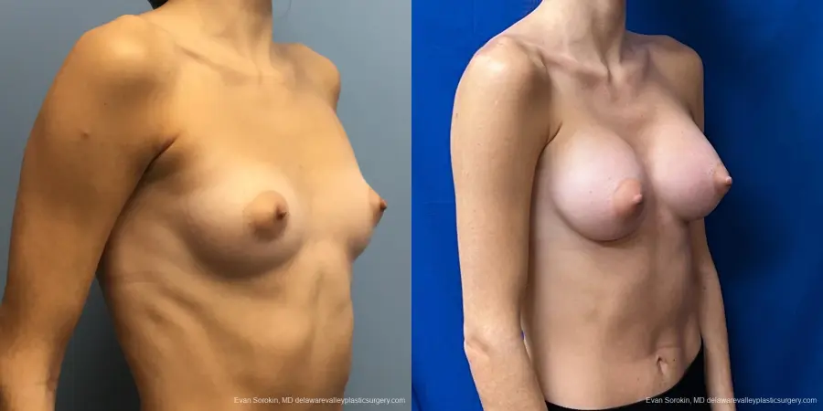 Breast Augmentation: Patient 226 - Before and After 2