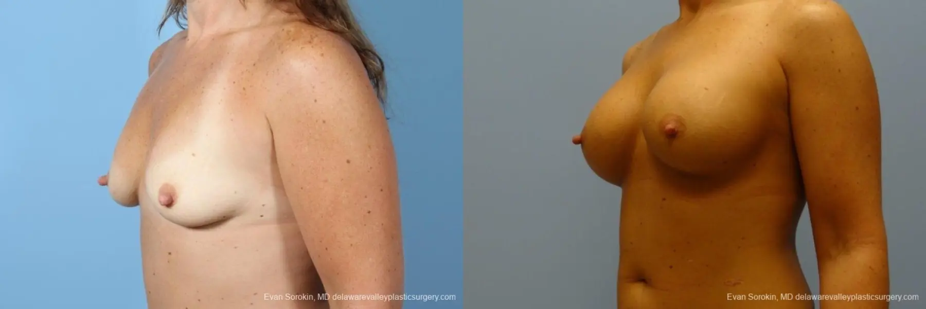 Philadelphia Breast Augmentation 8774 - Before and After 3