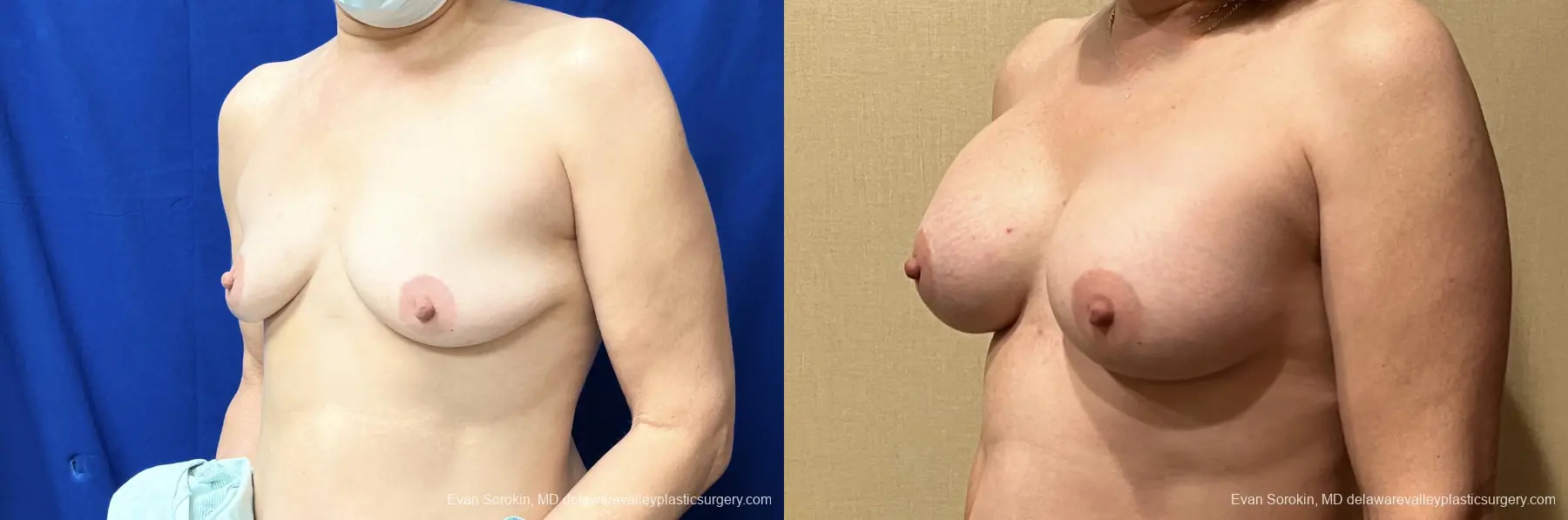 Breast Augmentation: Patient 215 - Before and After 4