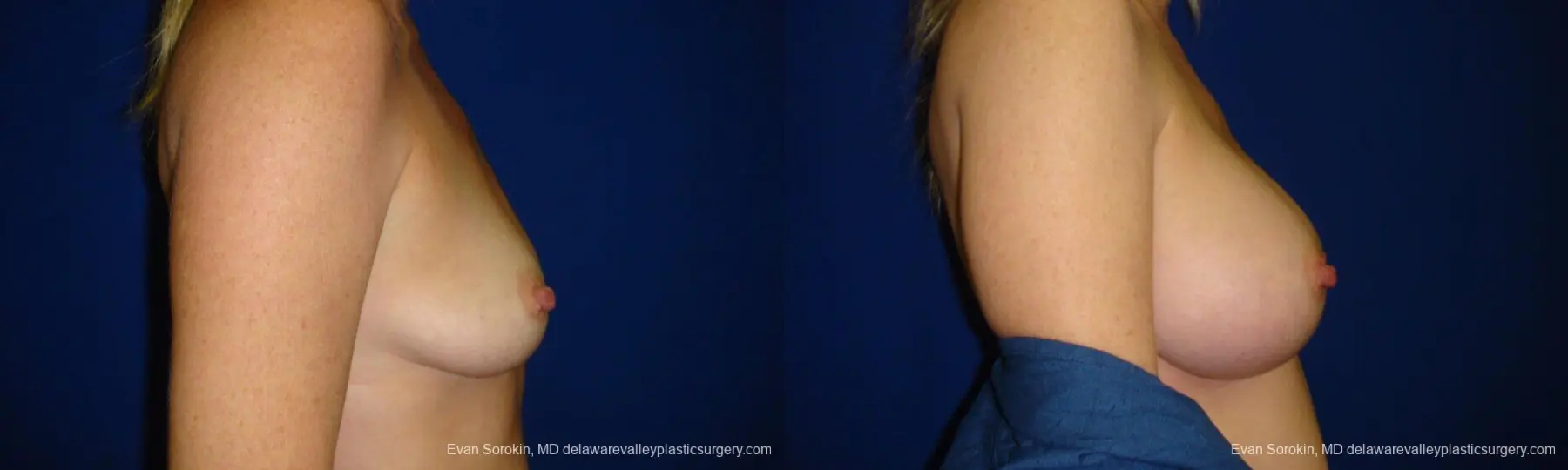 Philadelphia Breast Augmentation 9295 - Before and After 3