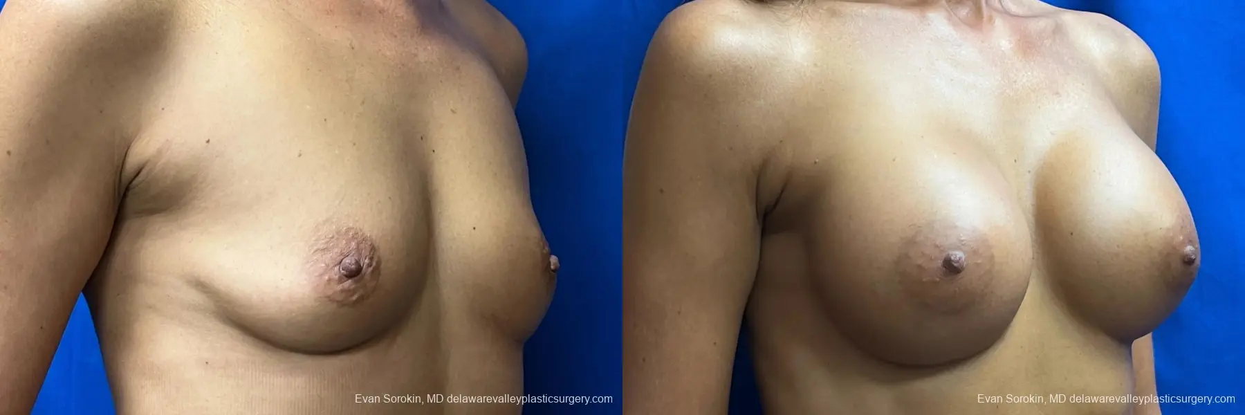 Breast Augmentation: Patient 10 - Before and After 2