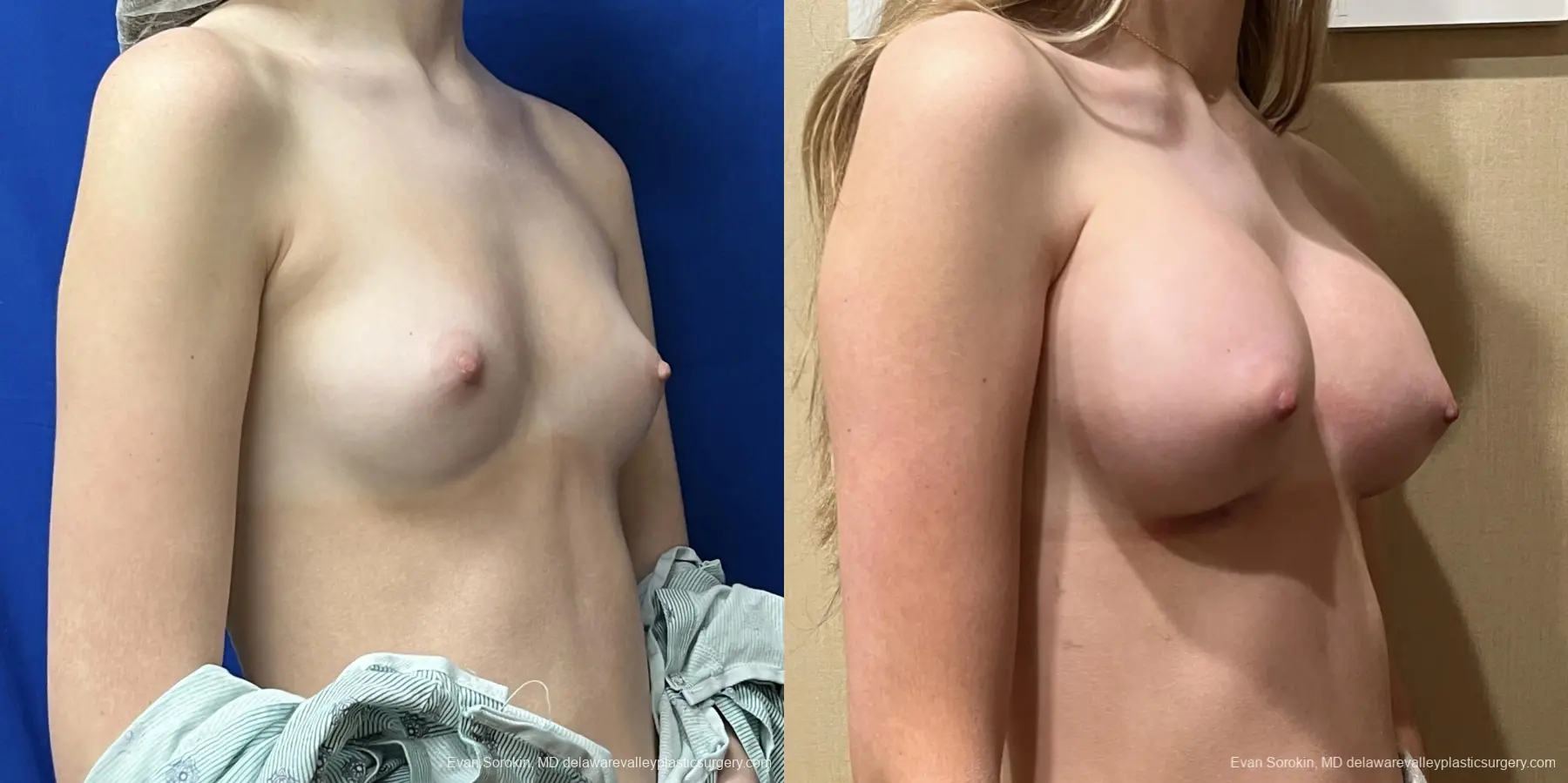 Breast Augmentation: Patient 212 - Before and After 2