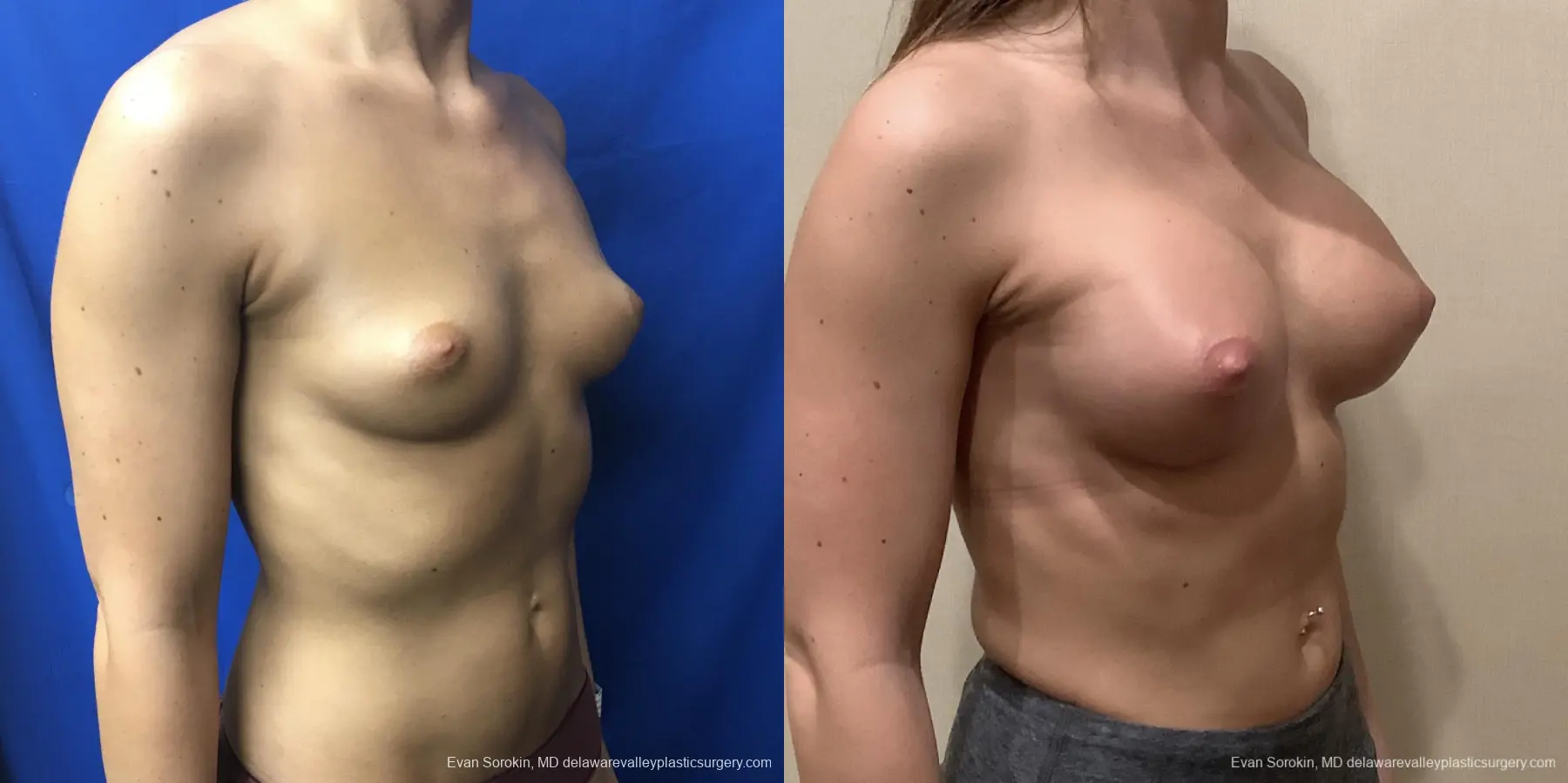Breast Augmentation: Patient 215 - Before and After 2