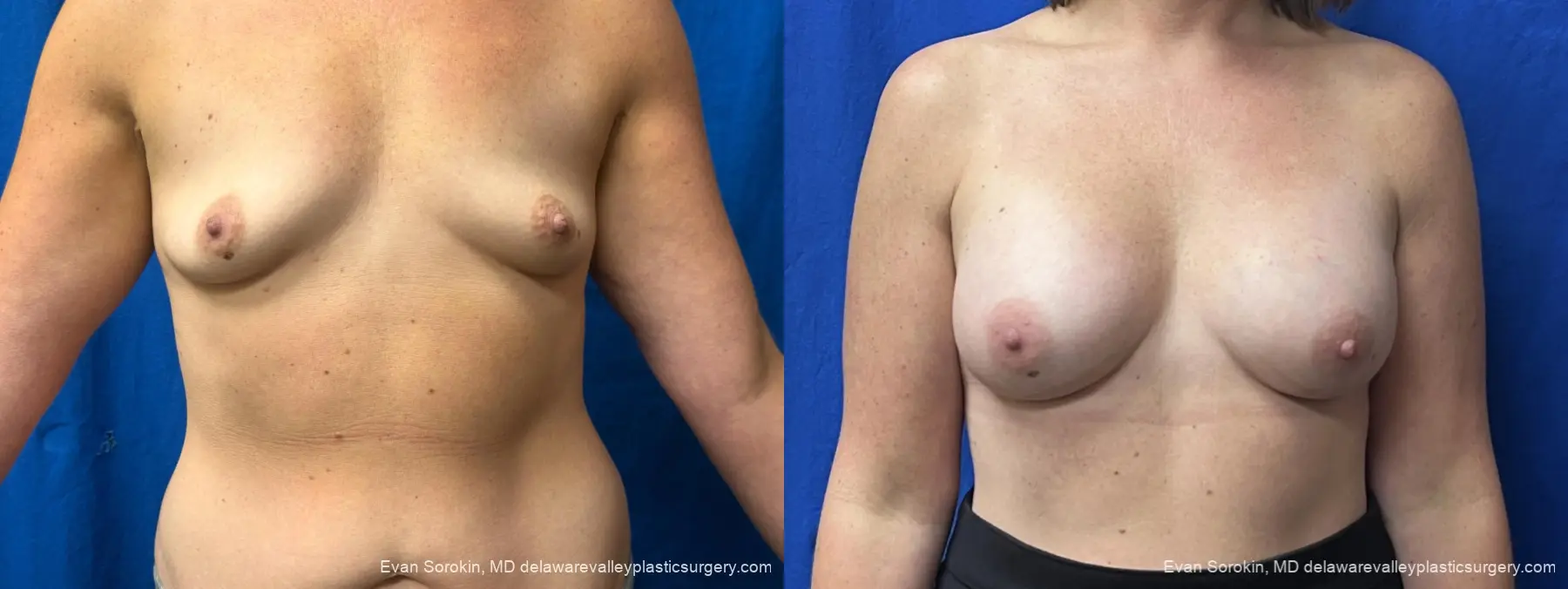 Breast Augmentation: Patient 337 - Before and After 1