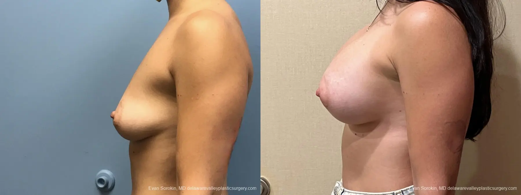 Breast Augmentation: Patient 204 - Before and After 5