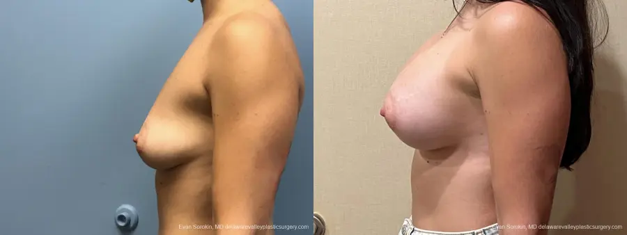 Breast Augmentation: Patient 237 - Before and After 5